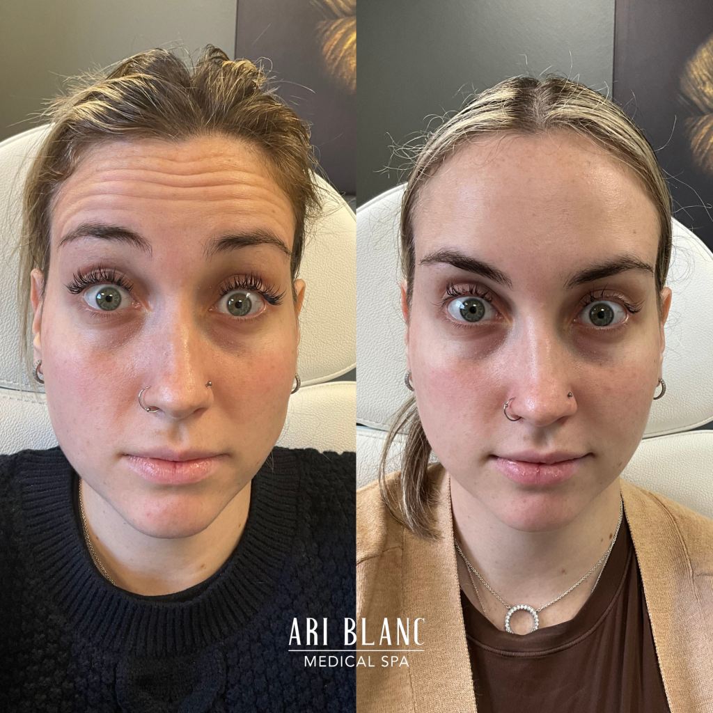 Dysport And Botox Before And After Gallery Ari Blanc Medical Spa