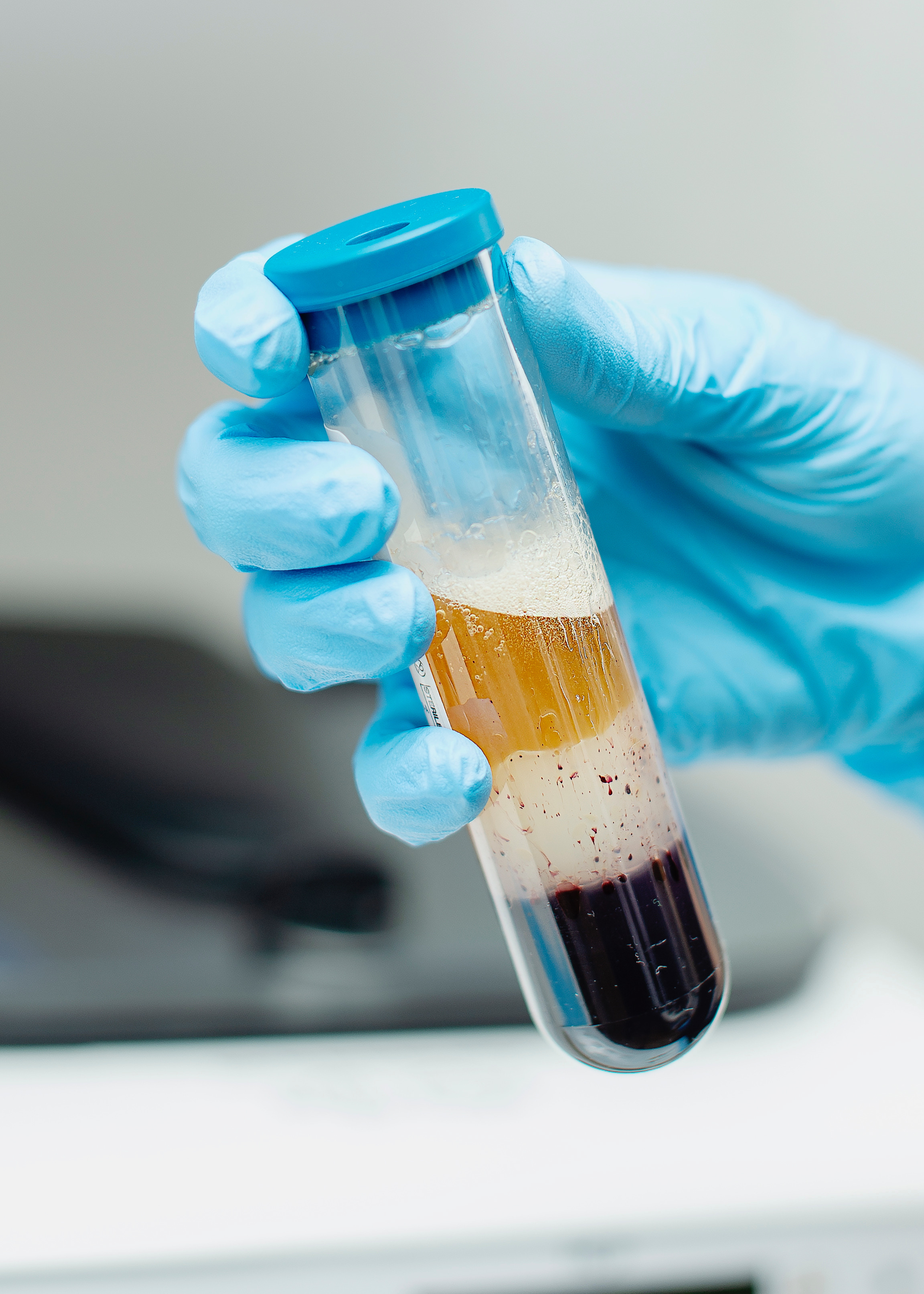 1 PRP in Philadelphia | Ari Blanc Medical Spa | Best Medical Spa | Platelet-Rich Plasma Therapy