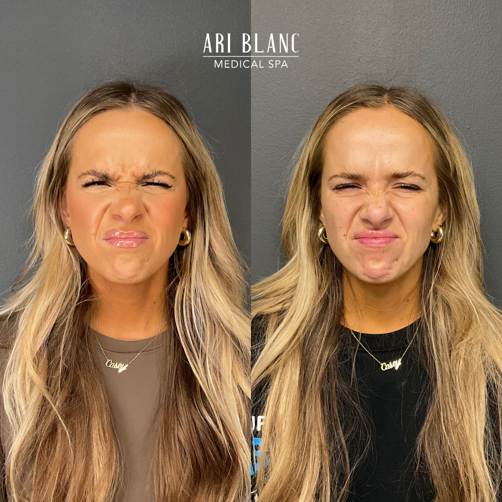 Anti Wrinkle Injection Botox Dysport Before and After Ari Blanc Medical Spa in Philadelphia Anti Wrinkle Injection Botox Dysport Before and After Ari Blanc Medical Spa in Philadelphia