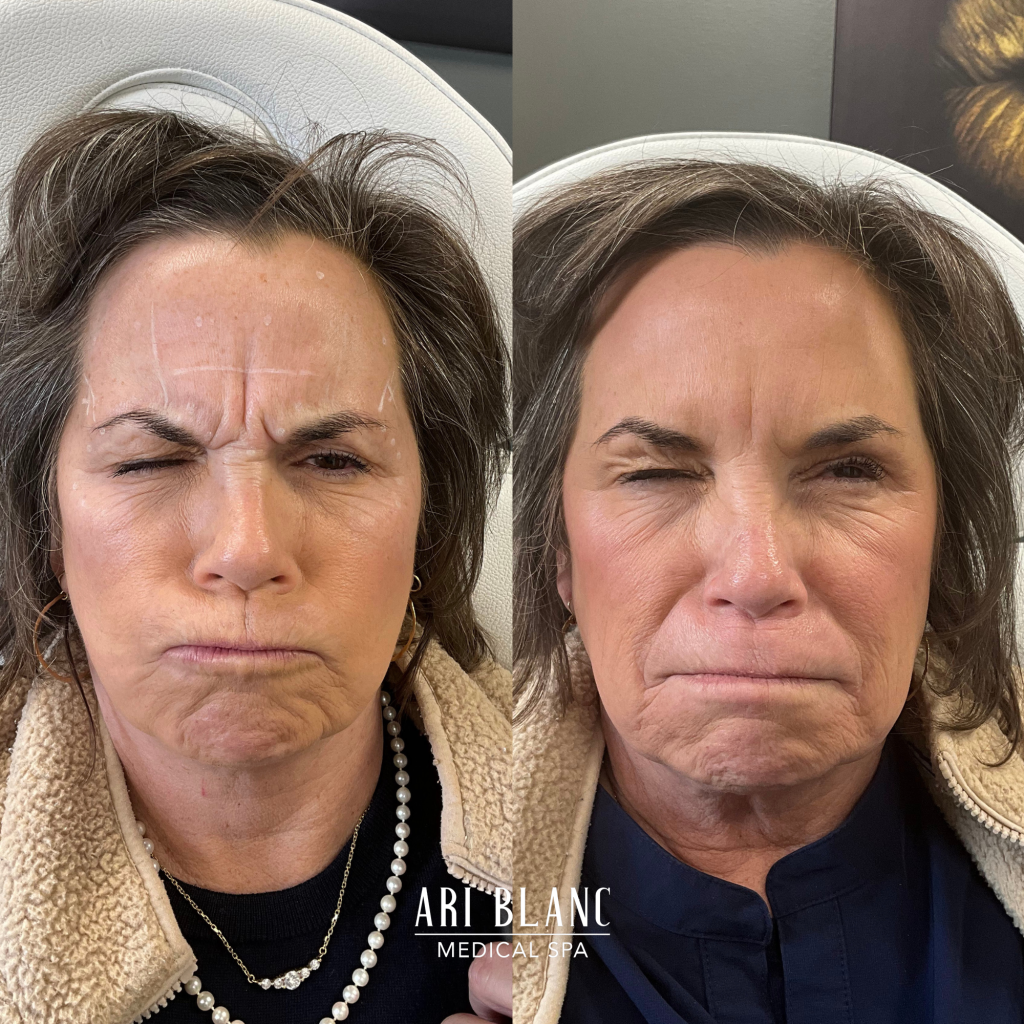 Anti Wrinkle Injection Botox Dysport Before and After in Philadelphia Ari Blanc Medical Spa Anti Wrinkle Injection Botox Dysport Before and After in Philadelphia Ari Blanc Medical Spa