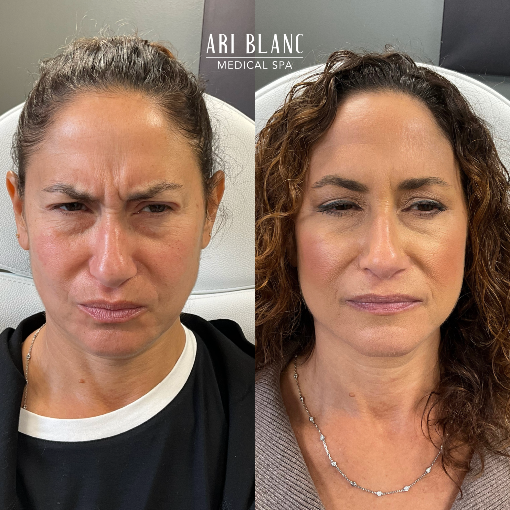 Anti Wrinkle Injections 11s Botox Dysport Before and After Forehead Ari Blanc Medical Spa in Philadelphia Anti Wrinkle Injections 11s Botox Dysport Before and After Forehead Ari Blanc Medical Spa in Philadelphia