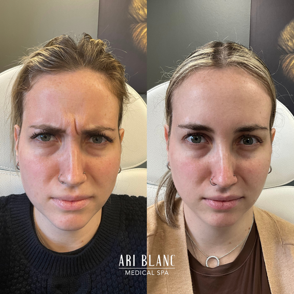Anti Wrinkle Injections Botox Dysport Before and After 11s Ari Blanc Medical Spa in Philadelphia Anti Wrinkle Injections Botox Dysport Before and After 11s Ari Blanc Medical Spa in Philadelphia