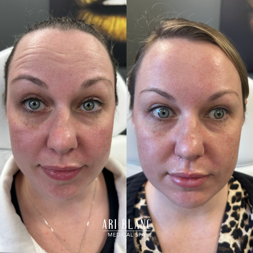 Anti Wrinkle Injections Botox Dysport Before and After Forehead Lines Ari Blanc Medical Spa in Philadelphia Anti Wrinkle Injections Botox Dysport Before and After Forehead Lines Ari Blanc Medical Spa in Philadelphia