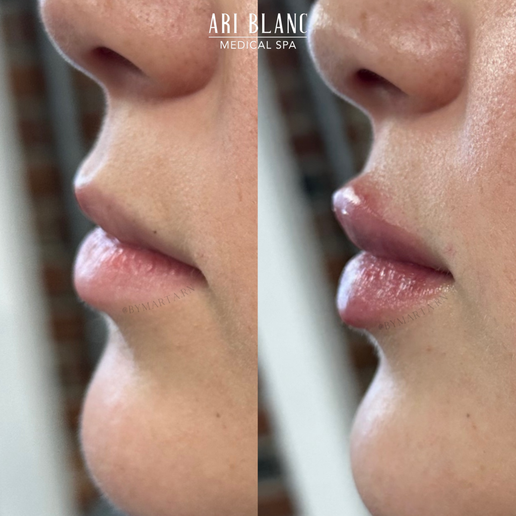 Lip Filler Before & After | Ari Blanc Medical Spa Philadelphia Ari Blanc Lip Filler Before & Afters Philadelphia Medical Spa 2