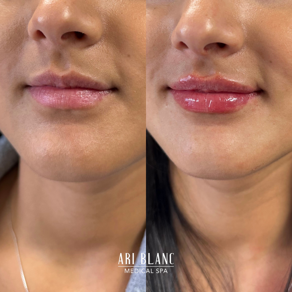 Lip Filler Before & After | Ari Blanc Medical Spa Philadelphia Ari Blanc Lip Filler Before & Afters Philadelphia Medical Spa 3