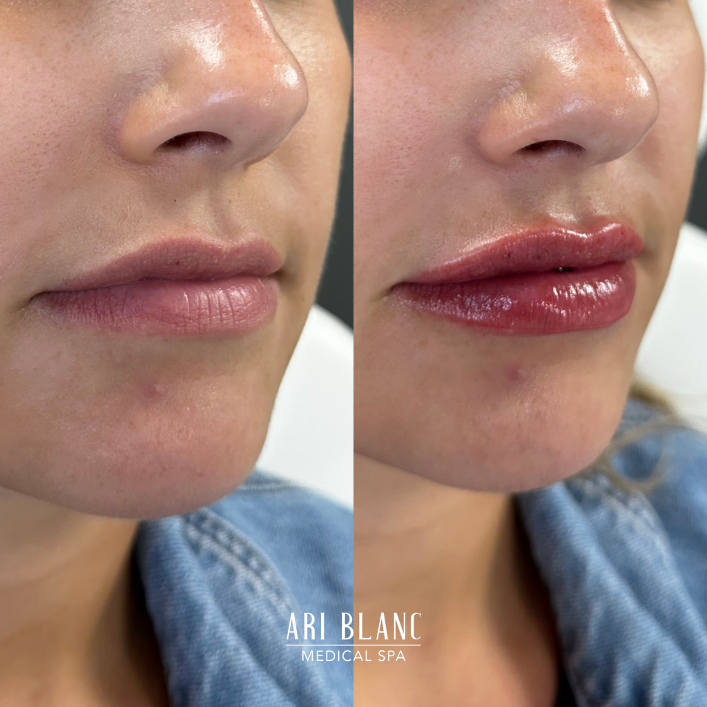Lip Filler Before & After | Ari Blanc Medical Spa Philadelphia Ari Blanc Lip Filler Before & Afters Philadelphia Medical Spa 4