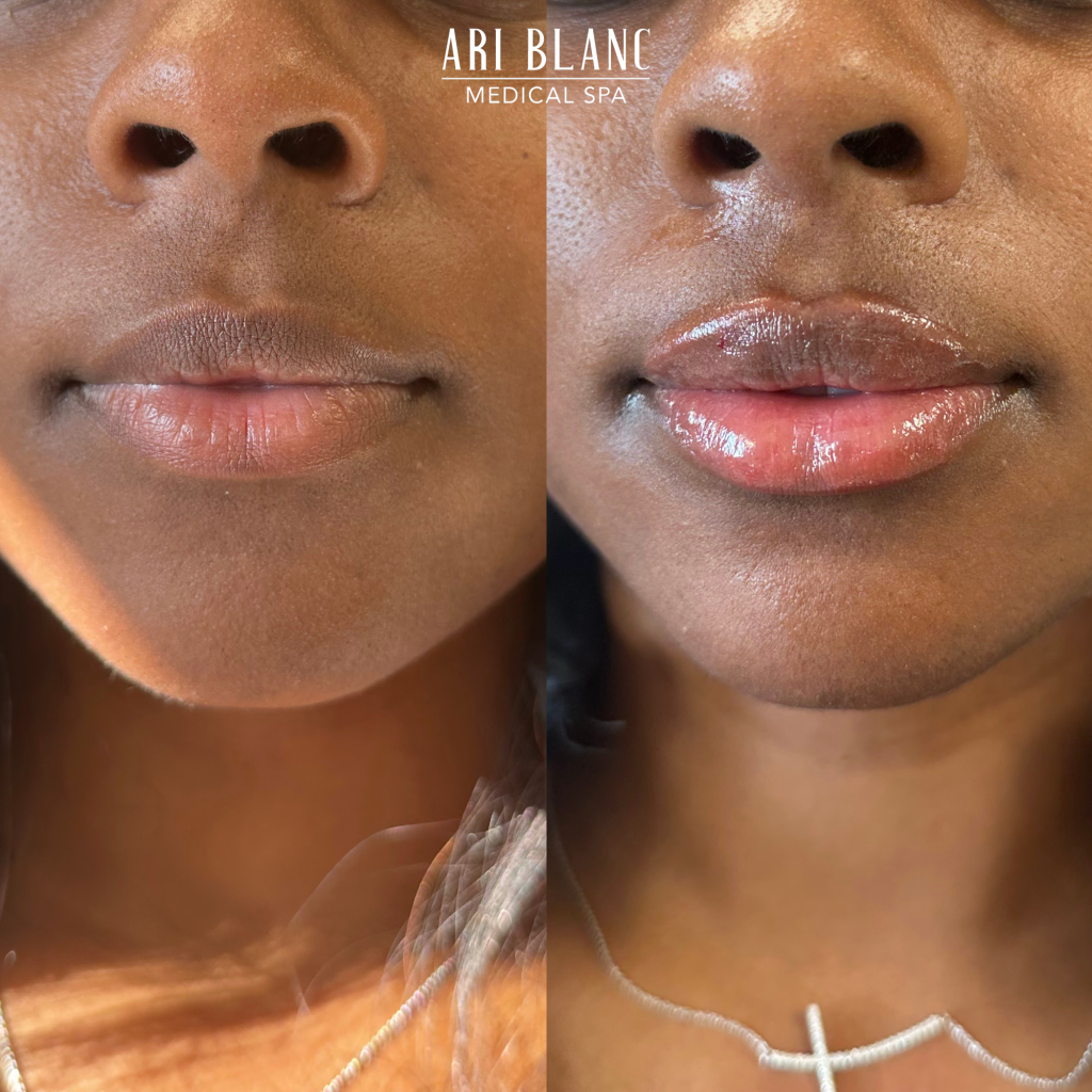 Lip Filler Before & After | Ari Blanc Medical Spa Philadelphia Ari Blanc Lip Filler Before & Afters Philadelphia Medical Spa 5