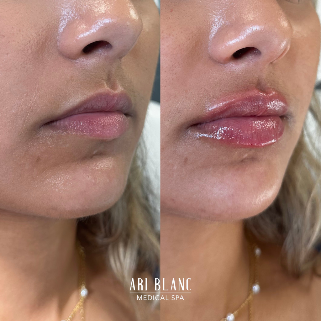 Lip Filler Before & After | Ari Blanc Medical Spa Philadelphia Ari Blanc Lip Filler Before & Afters Philadelphia Medical Spa 6