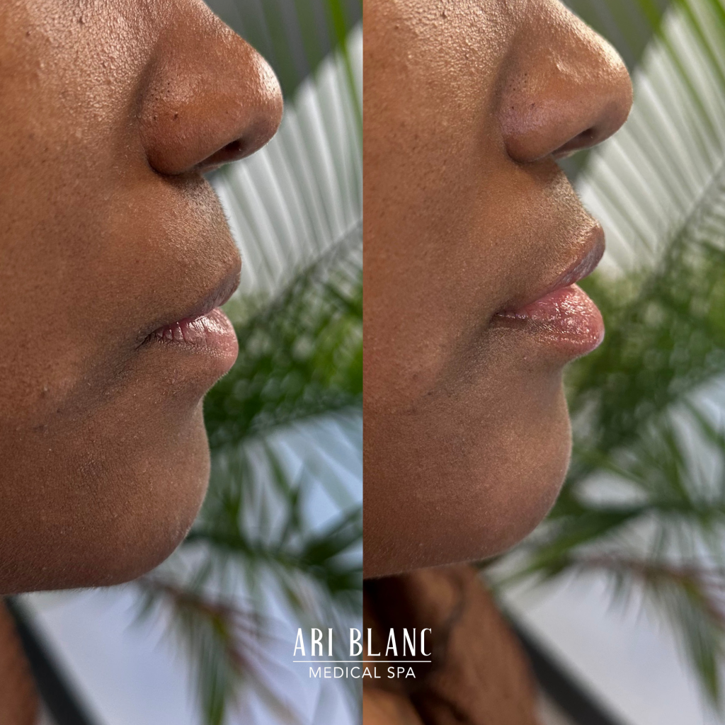 Lip Filler Before & After | Ari Blanc Medical Spa Philadelphia Ari Blanc Lip Filler Before & Afters Philadelphia Medical Spa 7