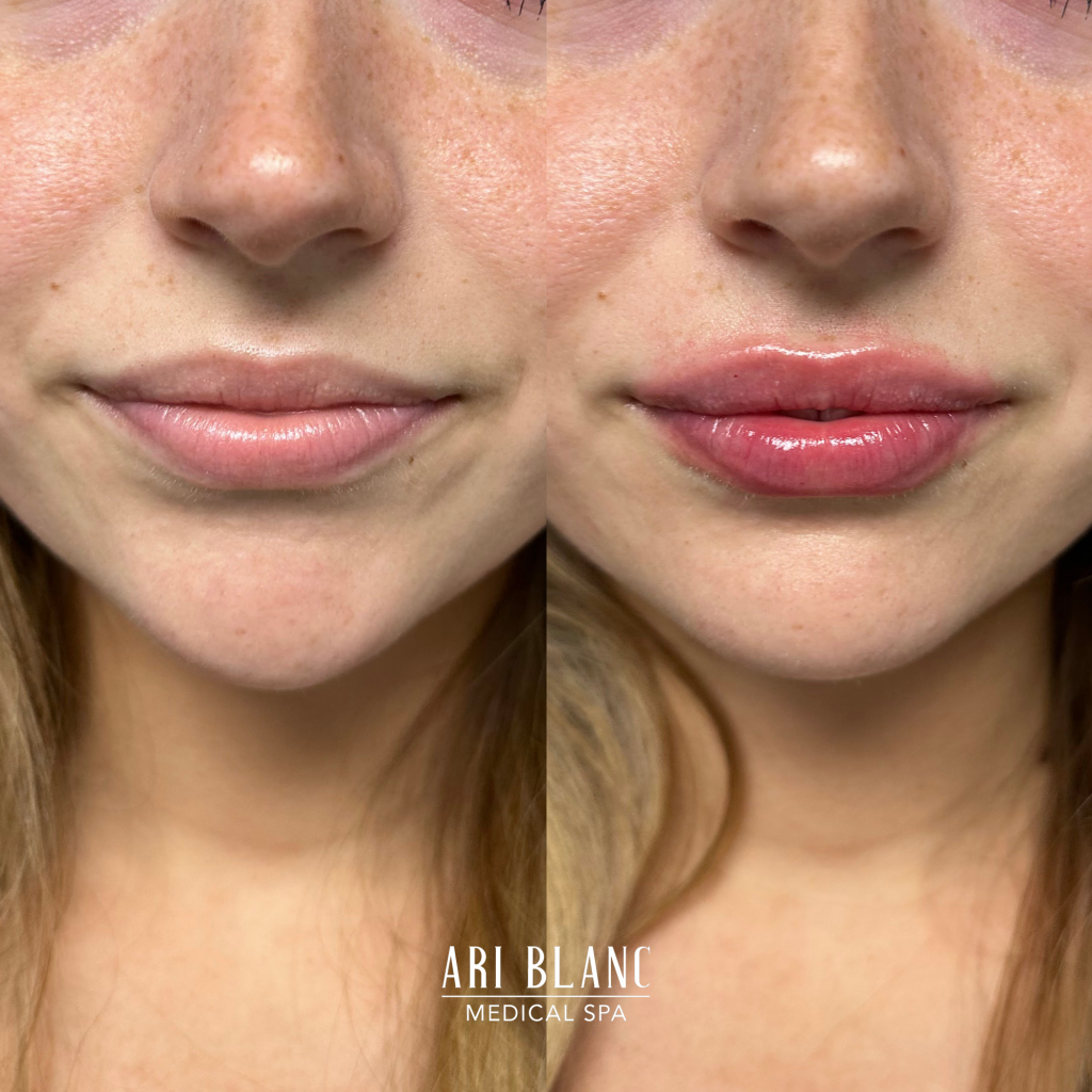 Lip Filler Before & After | Ari Blanc Medical Spa Philadelphia Ari Blanc Lip Filler Before & Afters Philadelphia Medical Spa 8
