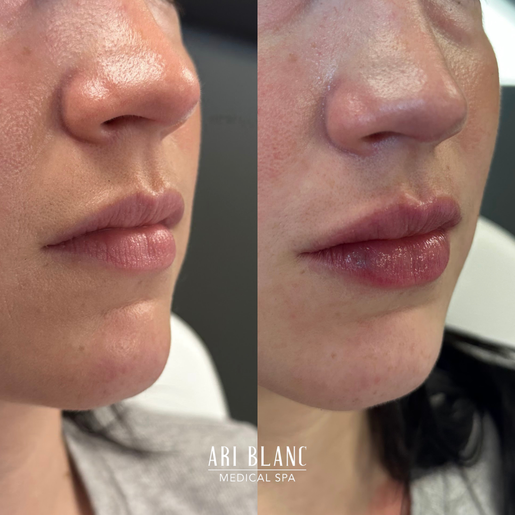 Lip Filler Before & After | Ari Blanc Medical Spa Philadelphia Lip Filler Before & After by Marta at Ari Blanc Medical Spa Philadelphia