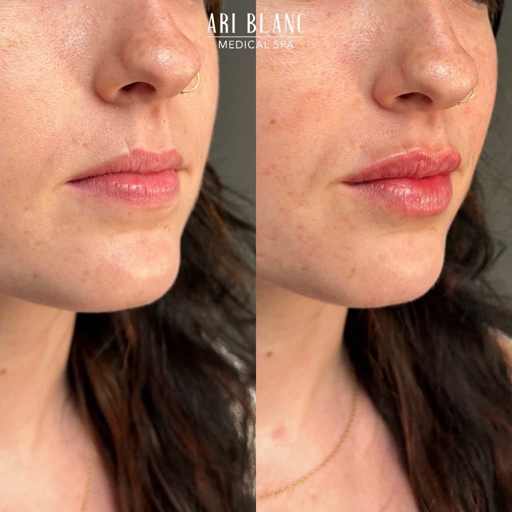 Lip Filler Before & After | Ari Blanc Medical Spa Philadelphia Ari Blanc Lip Filler in Philly Before & Afters Philadelphia Medical Spa