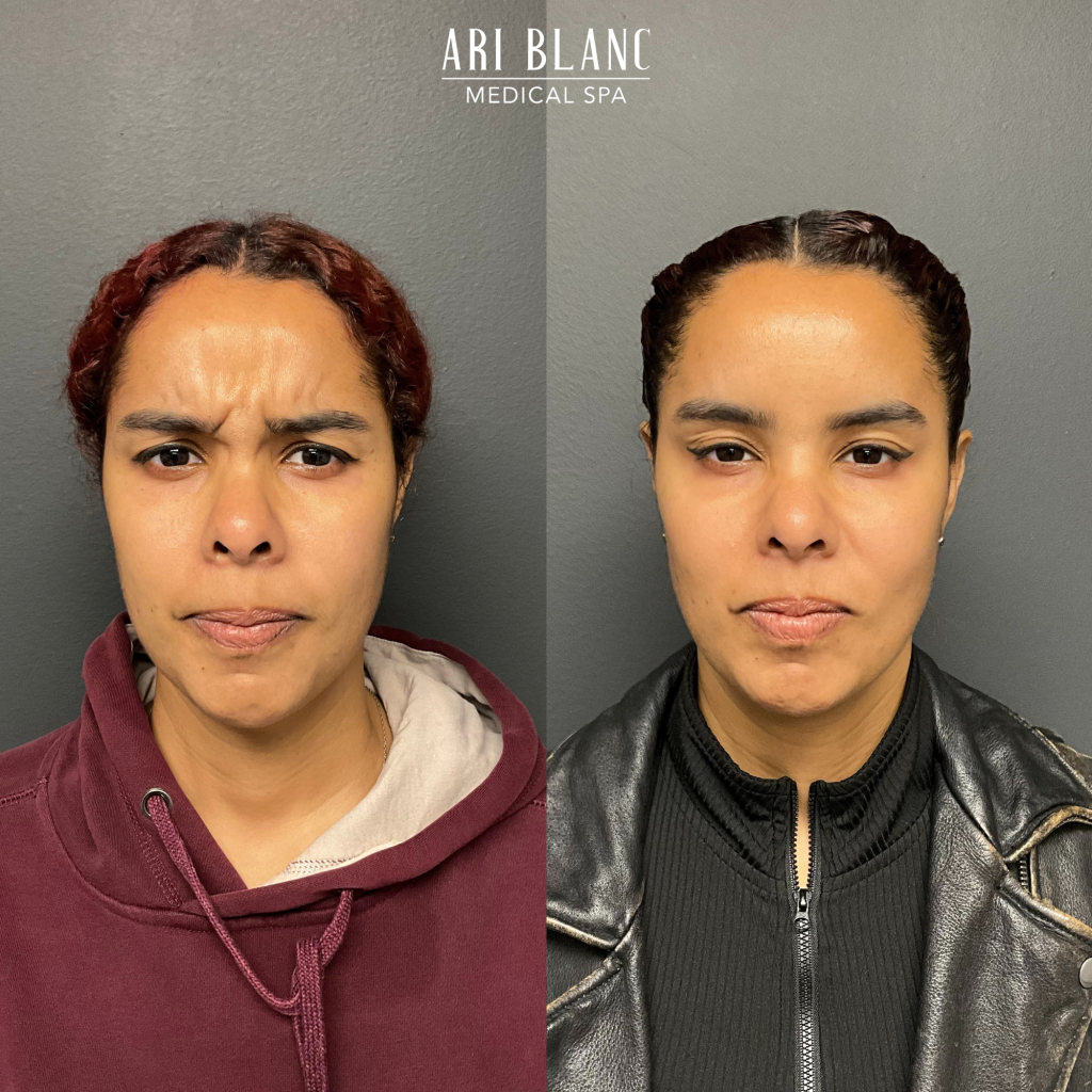 Botox Dysport Anti Wrinkle Injection Before and After in Philadelphia Ari Blanc Medical Spa Botox Dysport Anti Wrinkle Injection Before and After in Philadelphia Ari Blanc Medical Spa