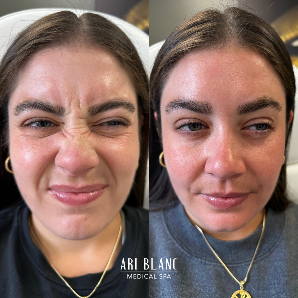 Botox Dysport Anti Wrinkle Tox Before and After in Philadelphia Ari Blanc Medical Spa Botox Dysport Anti Wrinkle Tox Before and After in Philadelphia Ari Blanc Medical Spa