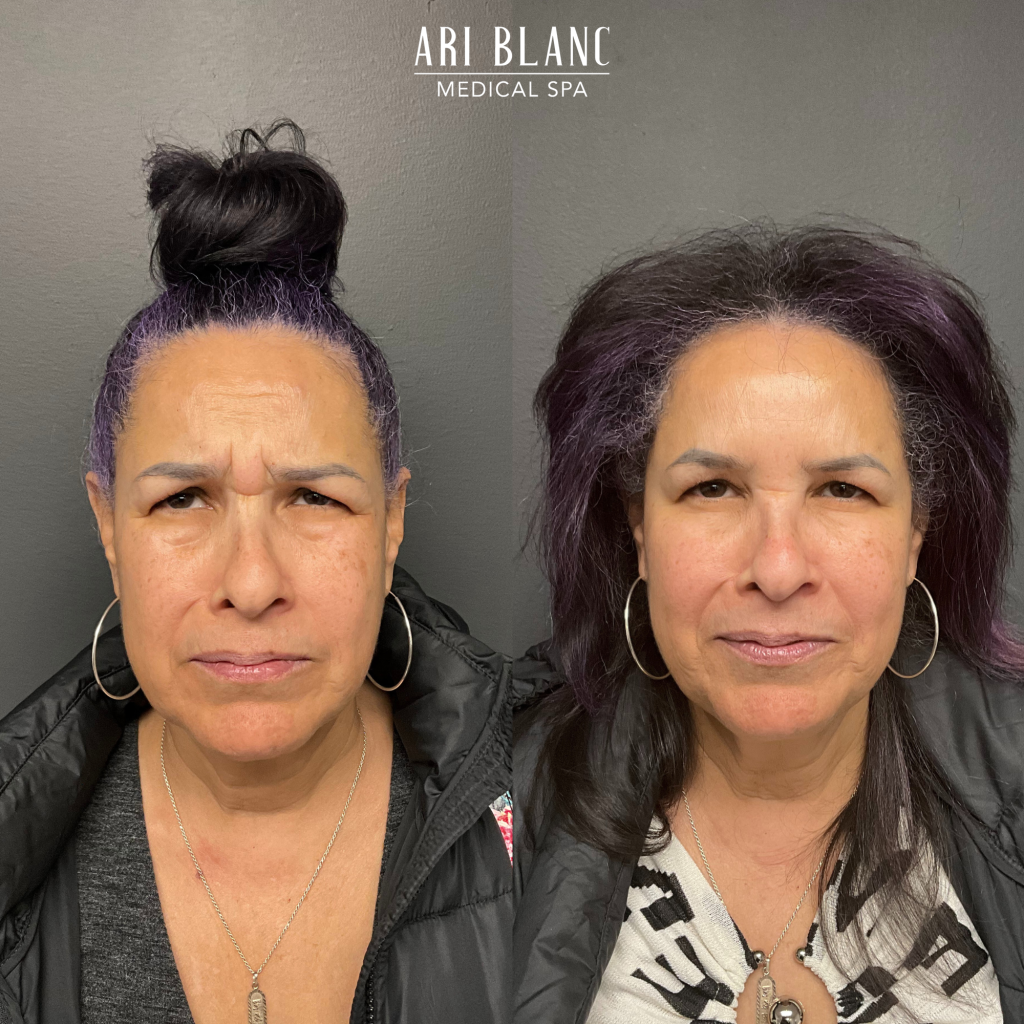 Dysport Botox Anti Wrinkle Tox Before and After in Philadelphia Ari Blanc Medical Spa Dysport Botox Anti Wrinkle Tox Before and After in Philadelphia Ari Blanc Medical Spa