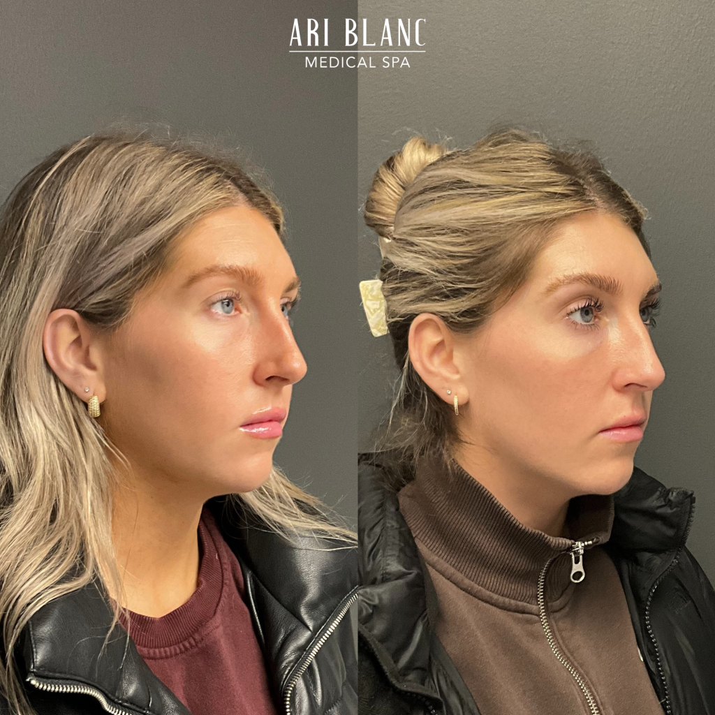 Facial Balancing in Philadelphia Ari Blanc Medical Spa Before and After Facial Balancing in Philadelphia Ari Blanc Medical Spa Before and After