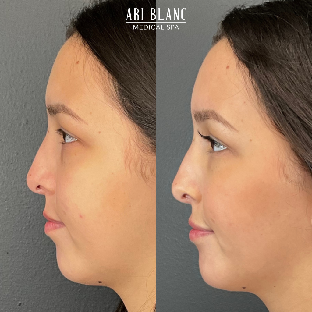 Facial Balancing in Philadelphia Ari Blanc Medical Spa Before and After 2 Facial Balancing in Philadelphia Ari Blanc Medical Spa Before and After 2