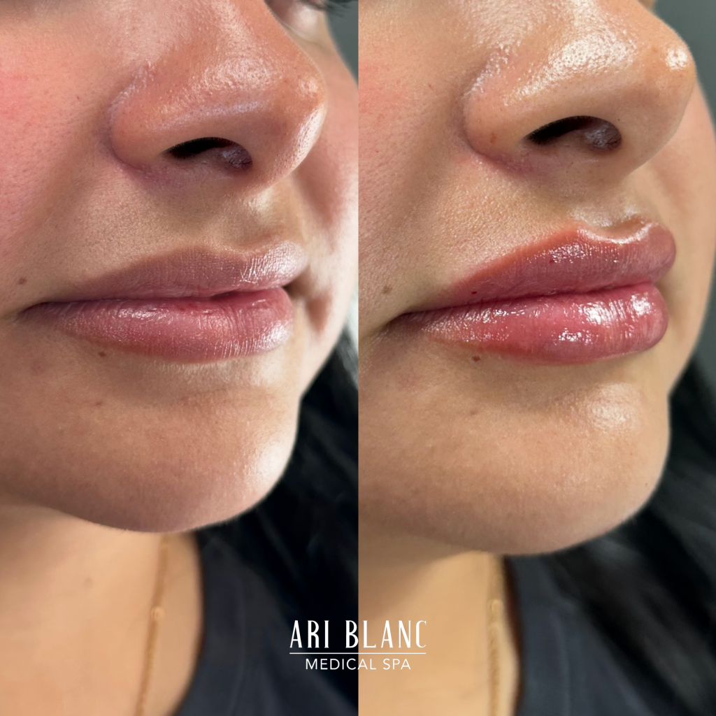 Lip Filler Before & After | Ari Blanc Medical Spa Philadelphia Lip Filler Before & Afters in Philadelphia Ari Blanc Medical Spa