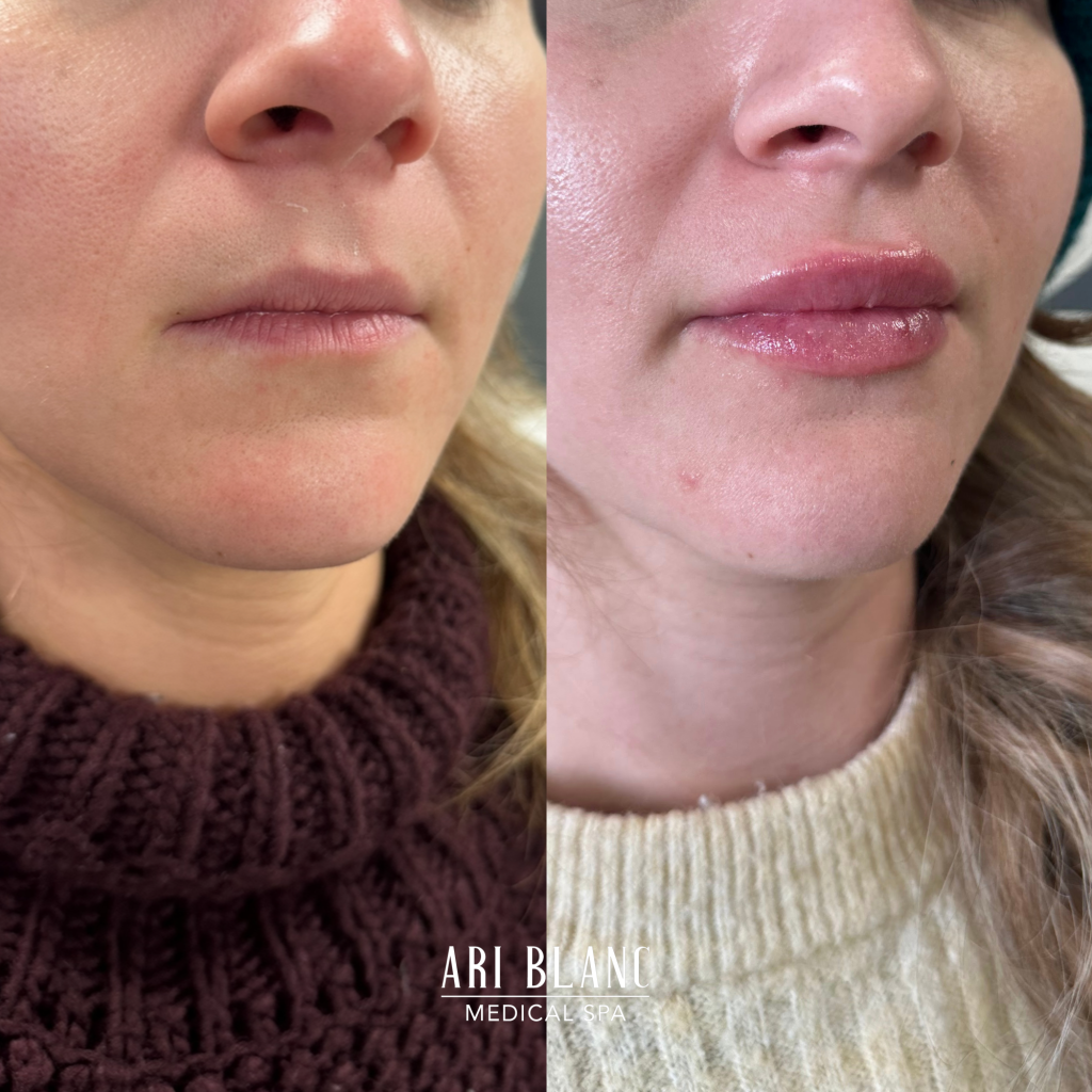 Lip Filler Before & After | Ari Blanc Medical Spa Philadelphia Lip Filler Before & Afters in Philadelphia Ari Blanc Medical Spa 11