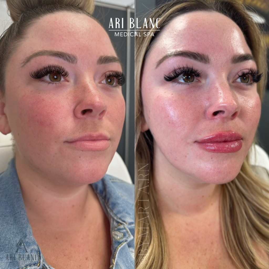 Lip Filler Before & After | Ari Blanc Medical Spa Philadelphia Lip Filler Before & Afters in Philadelphia Ari Blanc Medical Spa 2