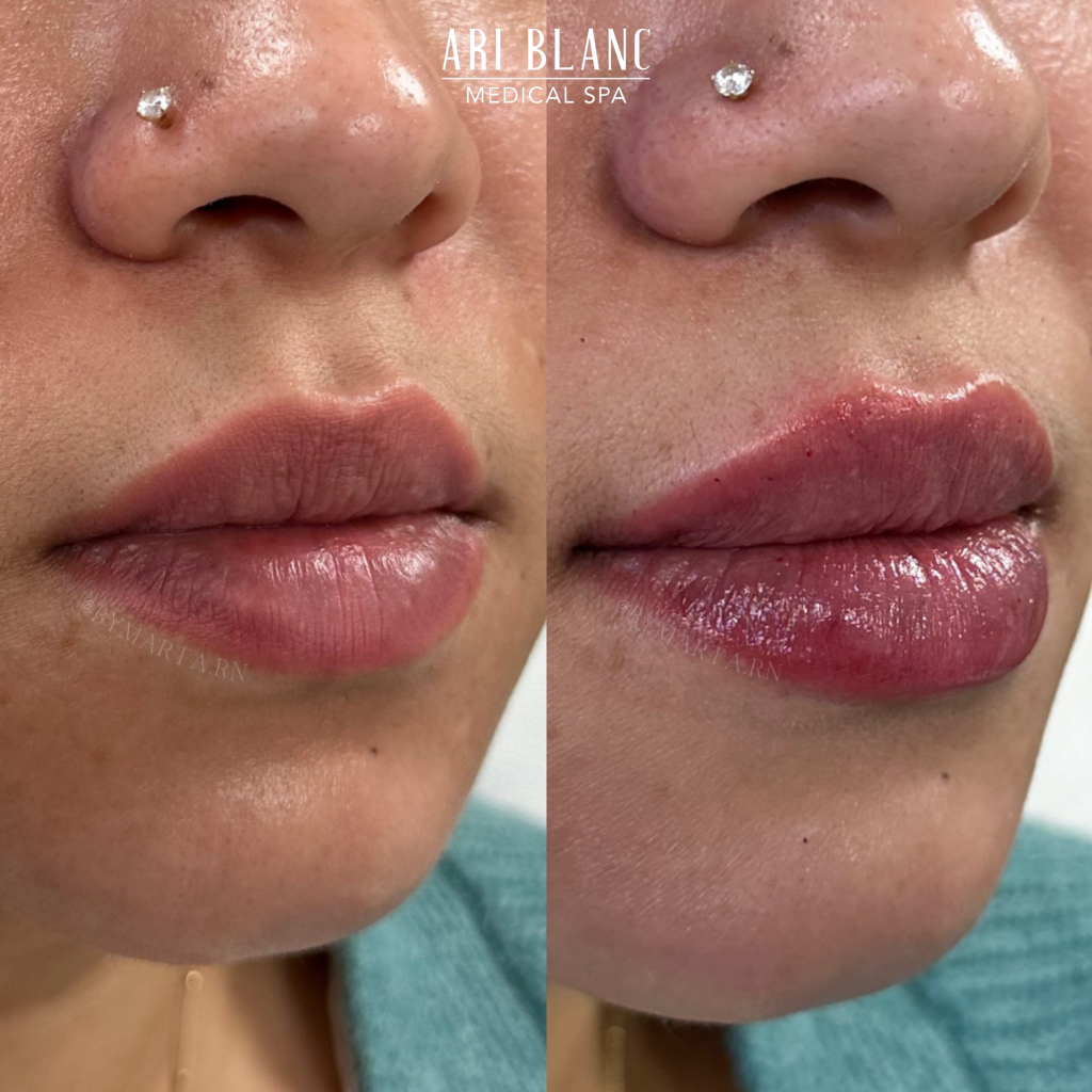 Lip Filler Before & After | Ari Blanc Medical Spa Philadelphia Lip Filler Before & Afters in Philadelphia Ari Blanc Medical Spa 3