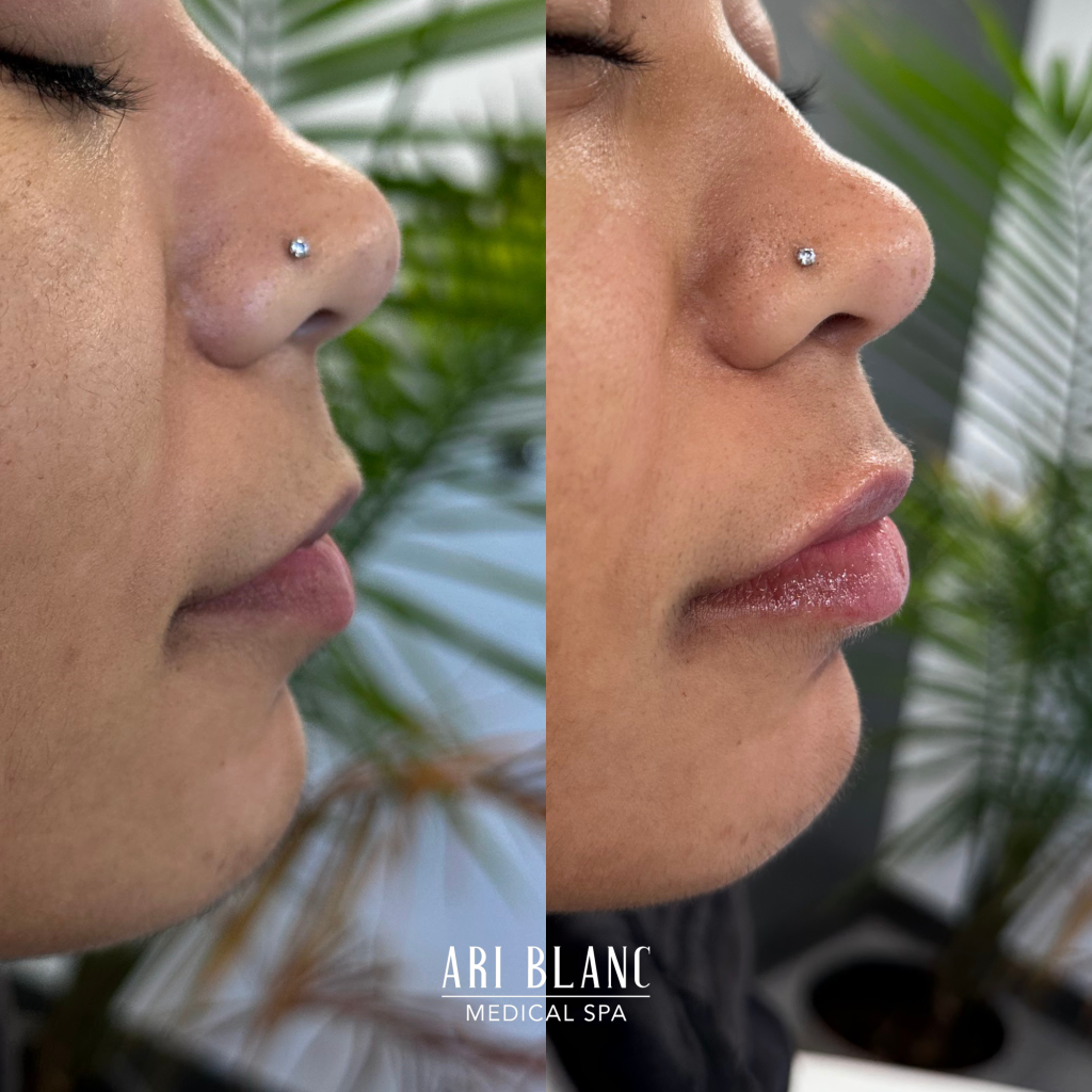 Lip Filler Before & After | Ari Blanc Medical Spa Philadelphia Lip Filler Before & Afters in Philadelphia Ari Blanc Medical Spa 4