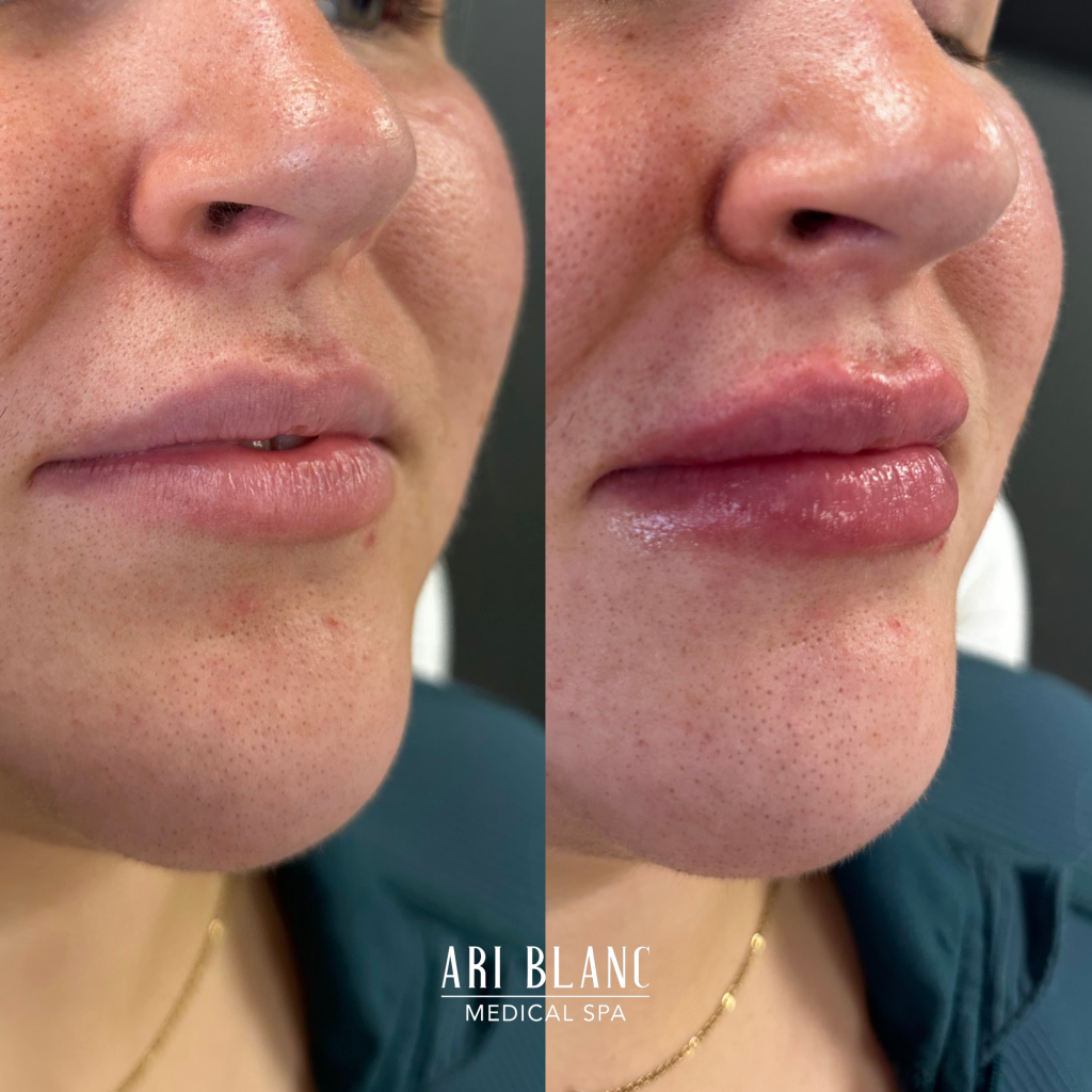 Lip Filler Before & After | Ari Blanc Medical Spa Philadelphia Lip Filler Before & Afters in Philadelphia Ari Blanc Medical Spa 5