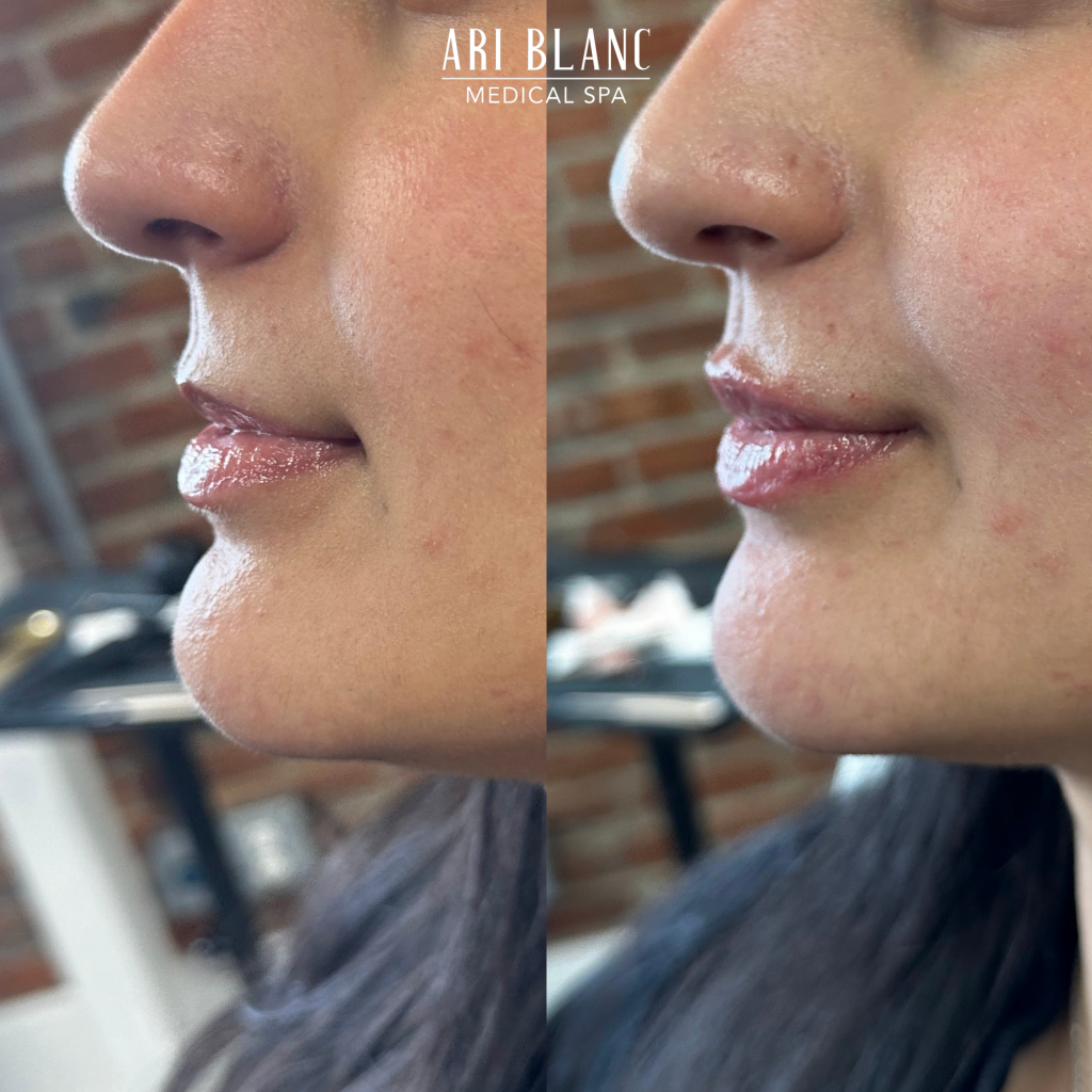 Lip Filler Before & After | Ari Blanc Medical Spa Philadelphia Lip Filler Before & Afters in Philadelphia Ari Blanc Medical Spa 6