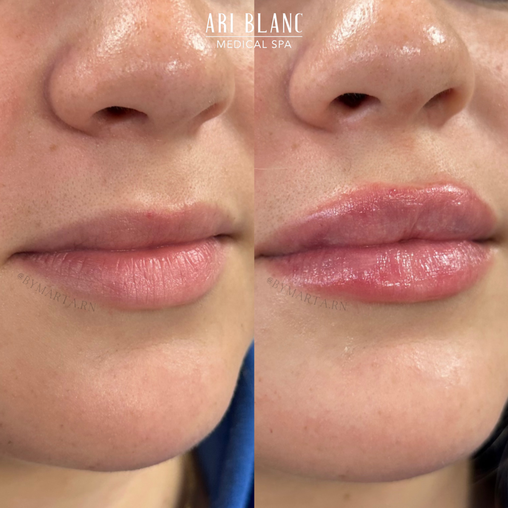 Lip Filler Before & After | Ari Blanc Medical Spa Philadelphia Lip Filler Before & Afters in Philadelphia Ari Blanc Medical Spa 7
