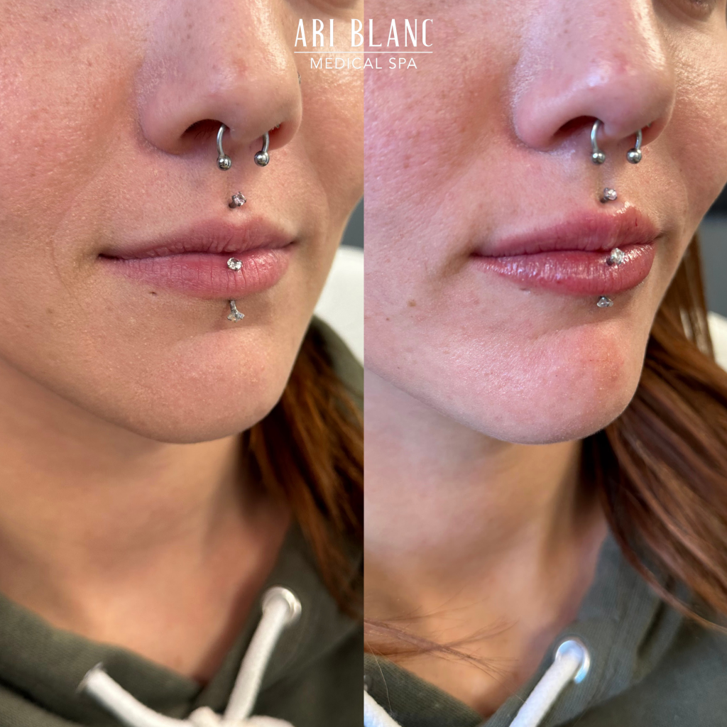 Lip Filler Before & After | Ari Blanc Medical Spa Philadelphia Lip Filler Before & Afters in Philadelphia Ari Blanc Medical Spa 8