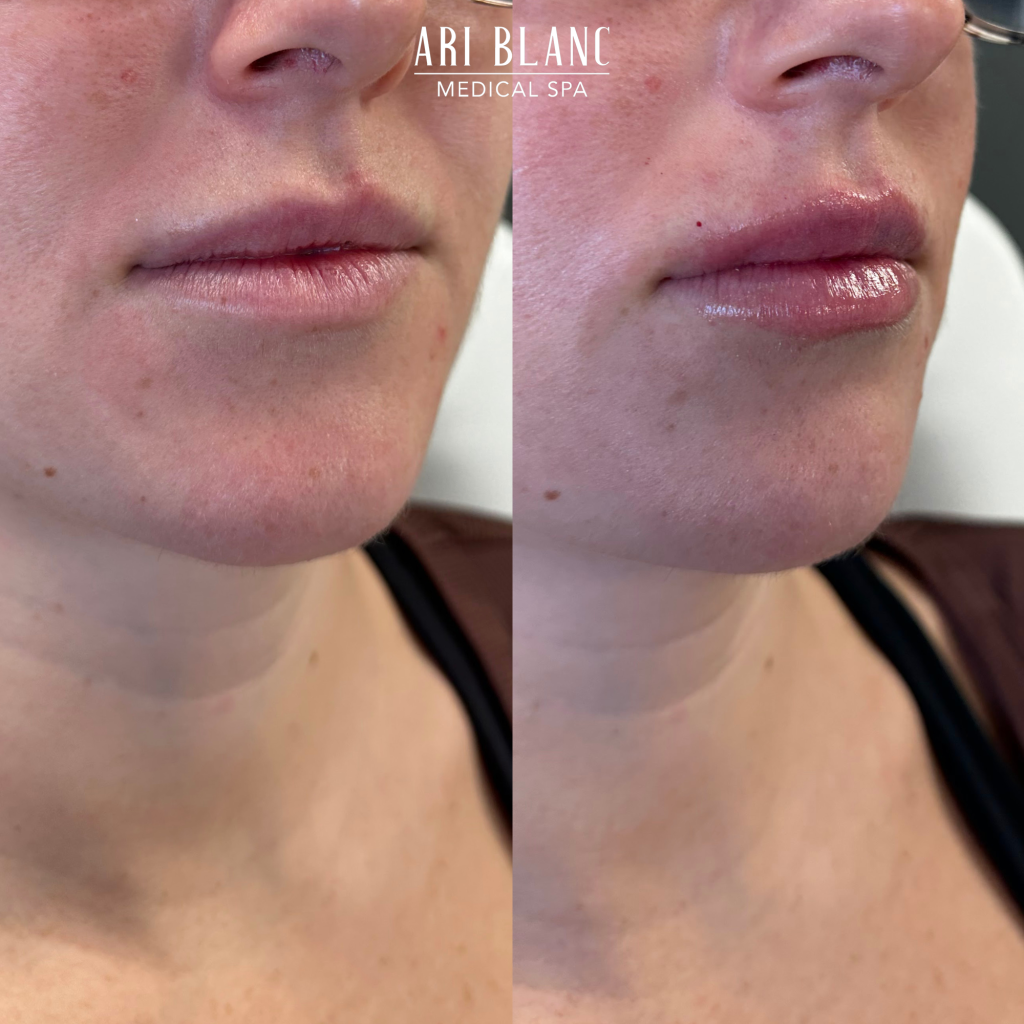 Lip Filler Before & After | Ari Blanc Medical Spa Philadelphia Lip Filler Before & Afters in Philadelphia Ari Blanc Medical Spa 9