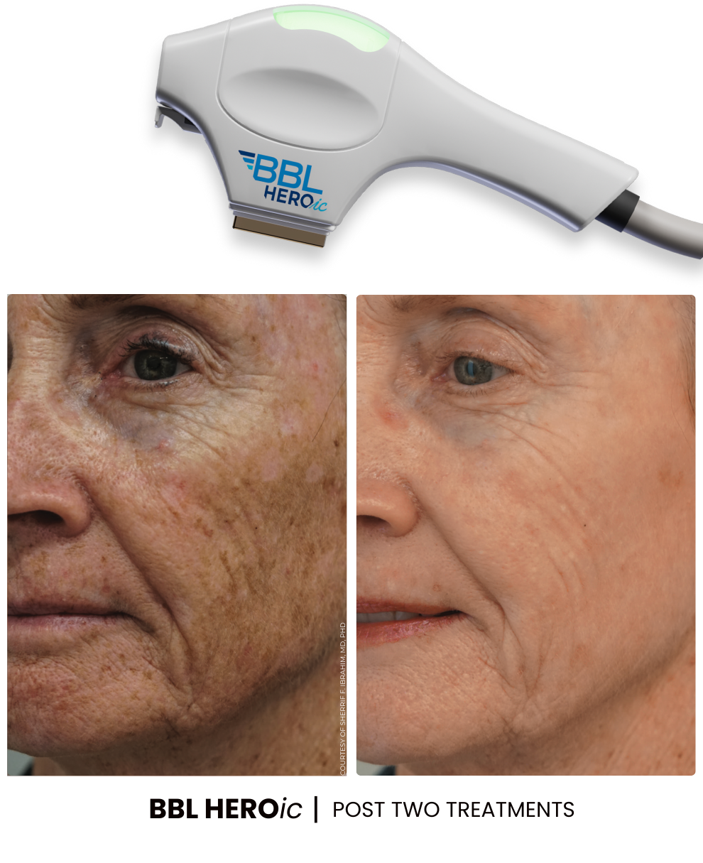 BBL Heroic Sciton Philadelphia