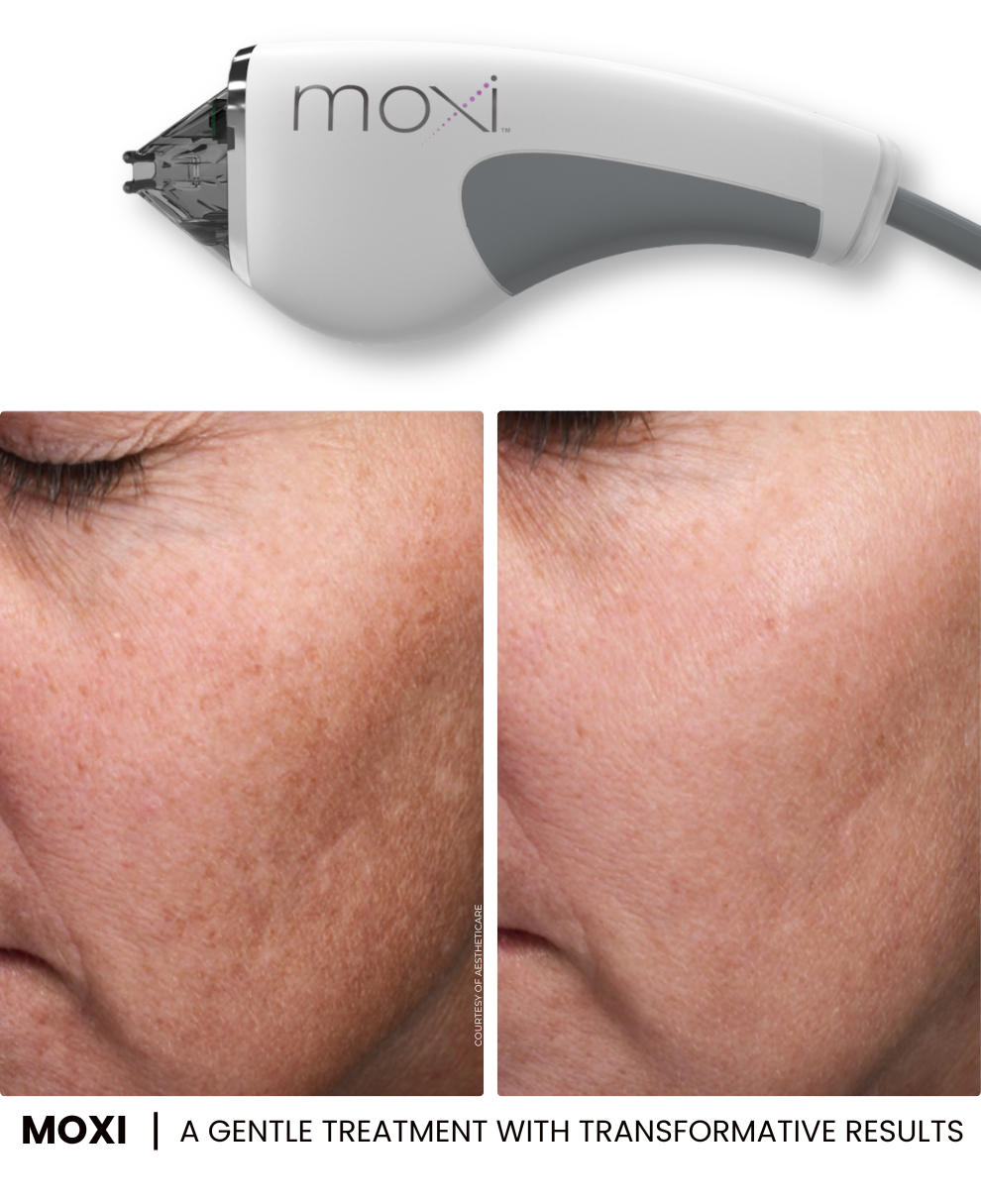 MOXI Before and After Sciton Results