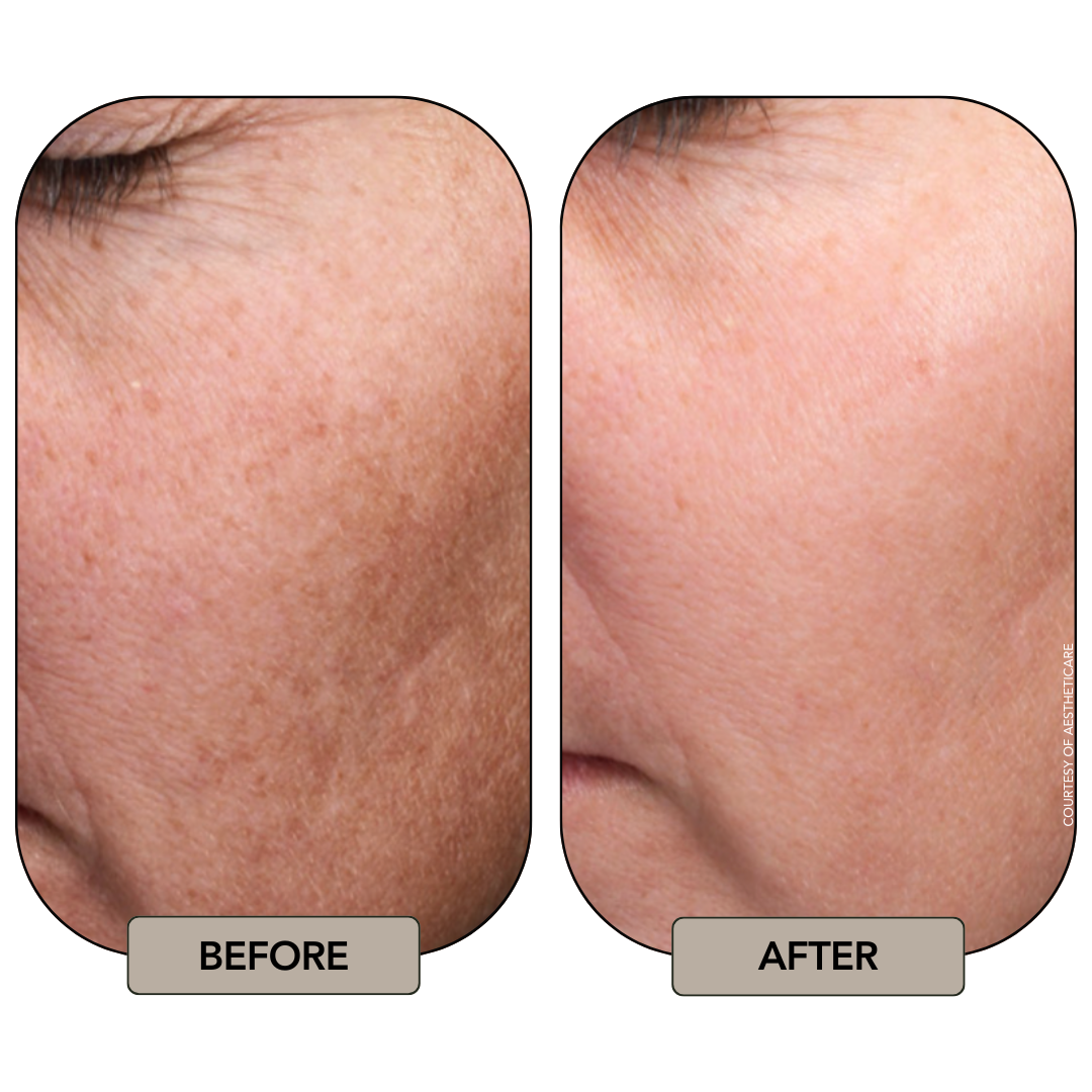 MOXI Sciton Laser Ari Blanc Med Spa Philly