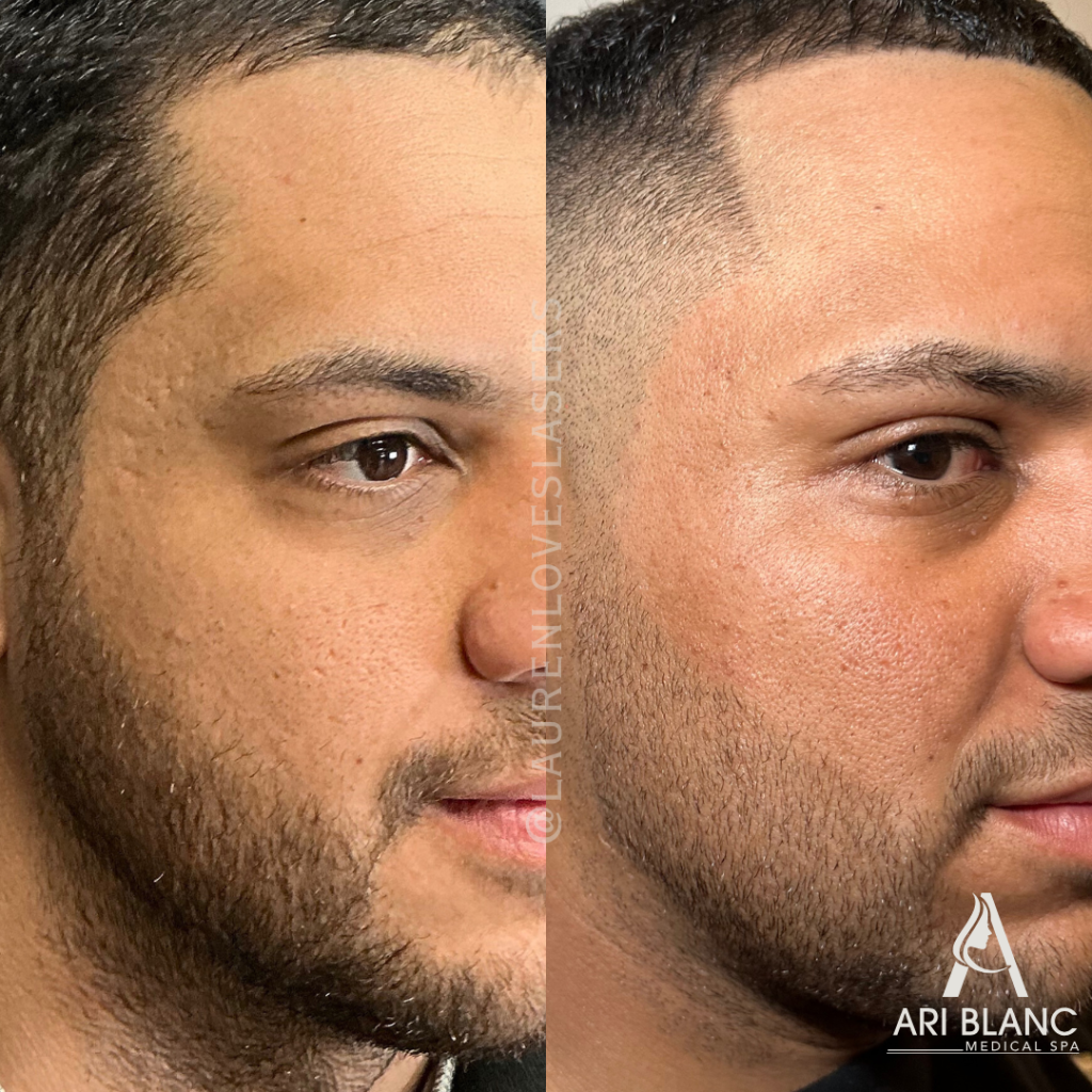 SkinPen Microneedling Acne Scar Before and After Philly | Ari Blanc Medical Spa SkinPen microneedling before and after in Philadelphia showing smoother cheek texture, softer acne scars, and more even-looking skin.