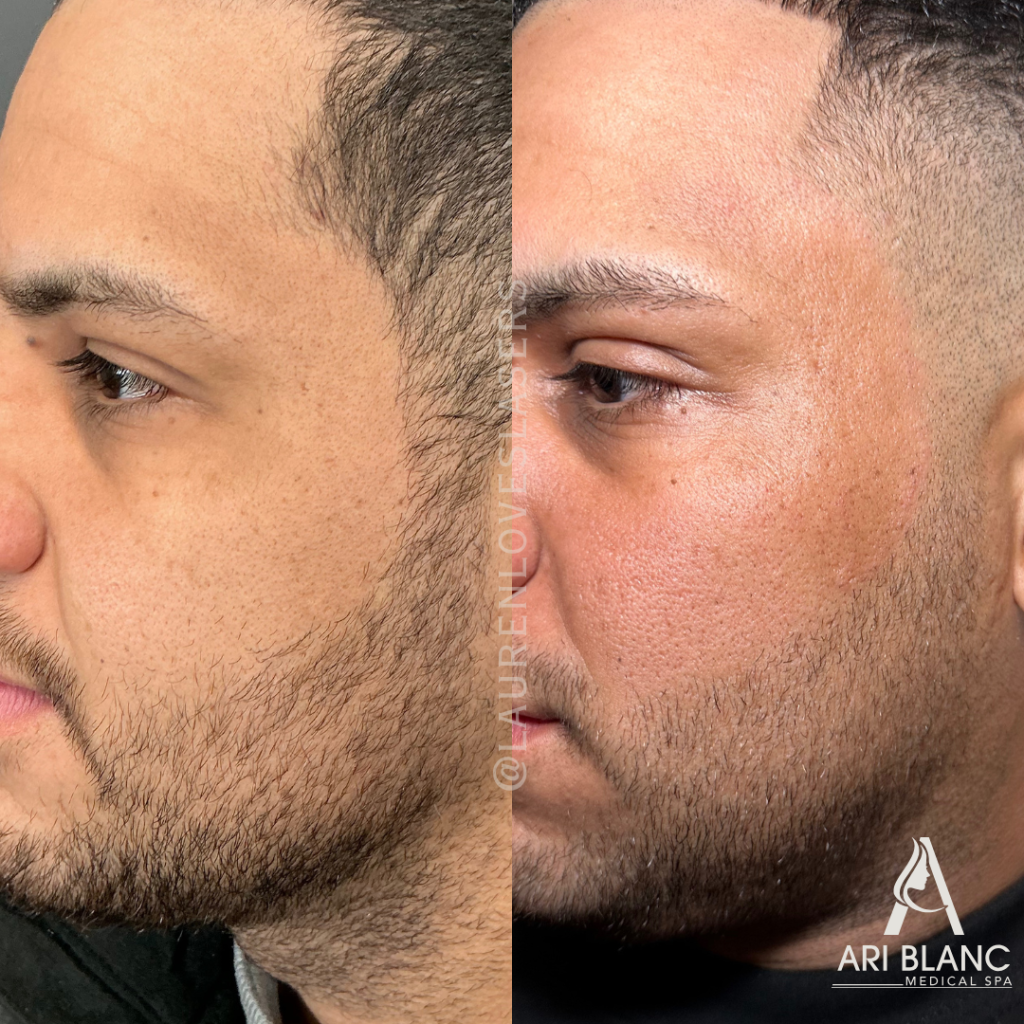 SkinPen Microneedling Acne Scar Before and After Philly | Ari Blanc Medical Spa SkinPen microneedling before and after in Philadelphia showing smoother cheek texture, softer acne scars, and more even-looking skin.