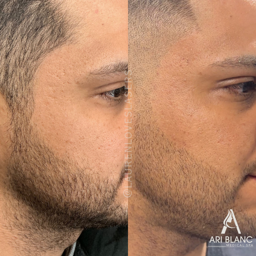 SkinPen Microneedling Acne Scar Before and After Philadelphia | Ari Blanc Medical Spa SkinPen microneedling before and after in Philadelphia showing smoother cheek texture, softer acne scars, and more even-looking skin.