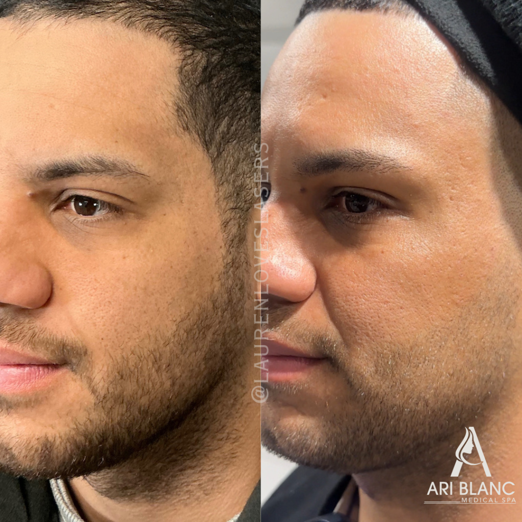 SkinPen Microneedling for Men - Skin Texture, Acne Scars, Large Pores Before and After Philadelphia | Ari Blanc Medical Spa SkinPen microneedling before and after side view in Philadelphia showing refined pores, smoother skin texture, and reduced acne scar visibility.