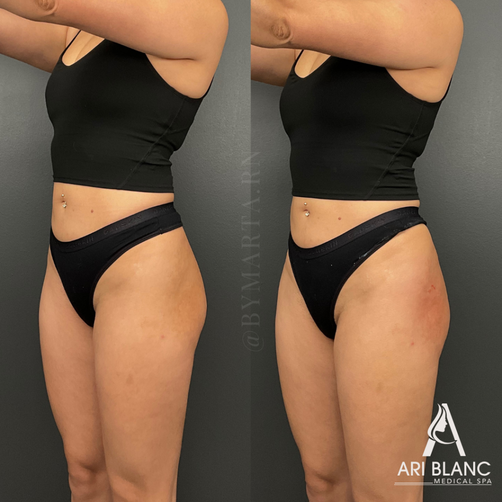 Non Surgical BBL Booty Butt Enhancement with Sculptra Philadelphia Ari Blanc Medical Spa Before and after front oblique photos of Sculptra non-surgical BBL in Philadelphia showing fuller hips, improved buttock shape, and softened hip dips.
