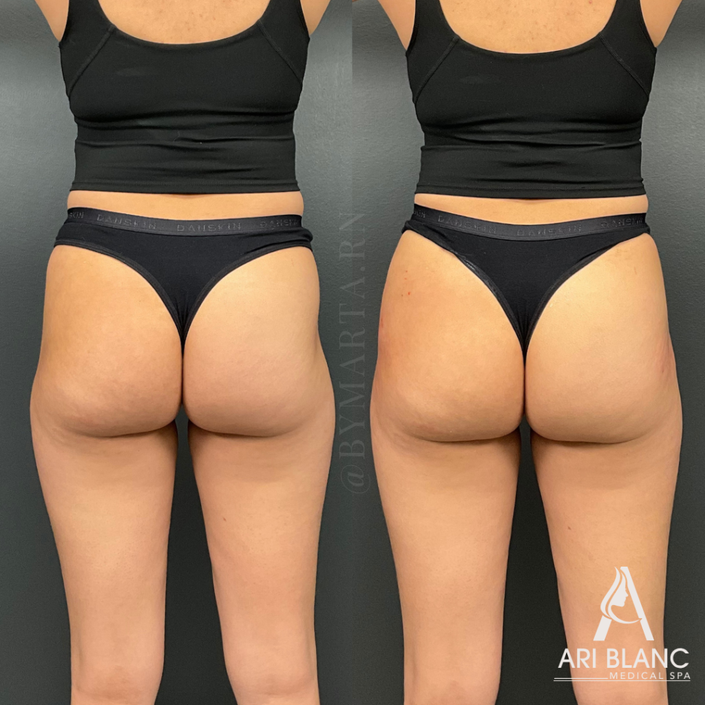 Sculptra Butt - Non Surgical BBL Booty - Enhancement Before and After Back View | Ari Blanc Before and after back view of Sculptra non-surgical BBL at Ari Blanc Medical Spa in Philadelphia showing fuller buttocks and improved overall contour.