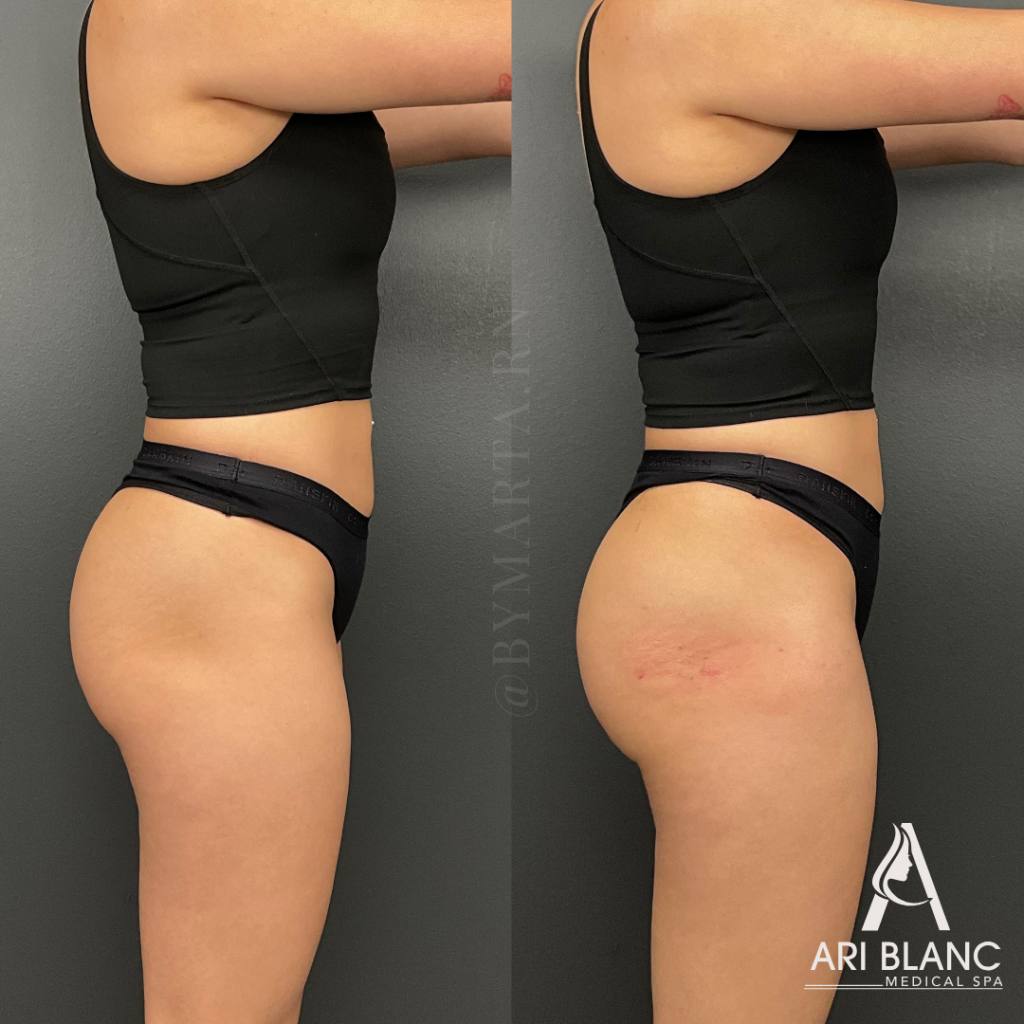 Non Surgical BBL Booty Enhancement with Sculptra Ari Blanc Medical Spa Before and after side-view photos of Sculptra butt injections in Philadelphia showing increased projection and enhanced non-surgical BBL results.