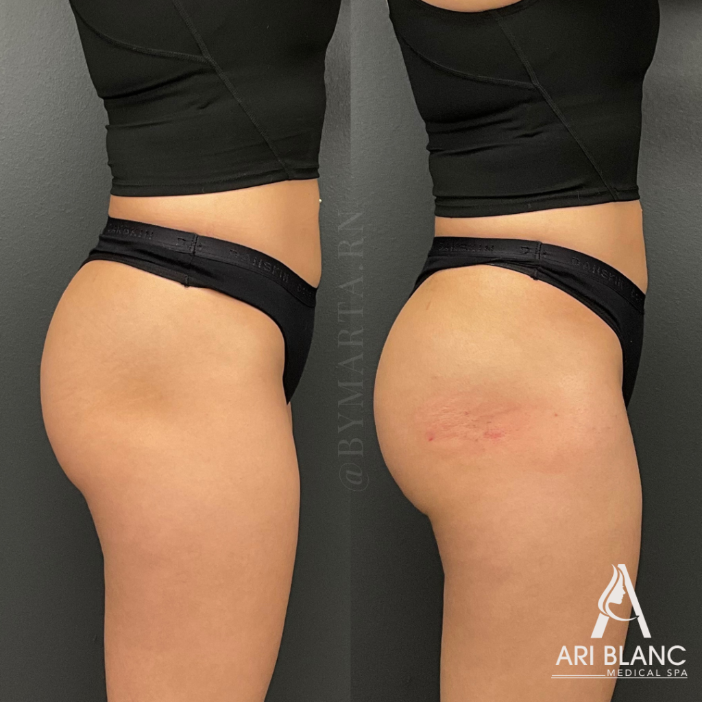Non Surgical BBL Butt Enhancement Ari Blanc Medical Spa Before and after side-view photos of Sculptra butt injections in Philadelphia showing increased projection and enhanced non-surgical BBL results.