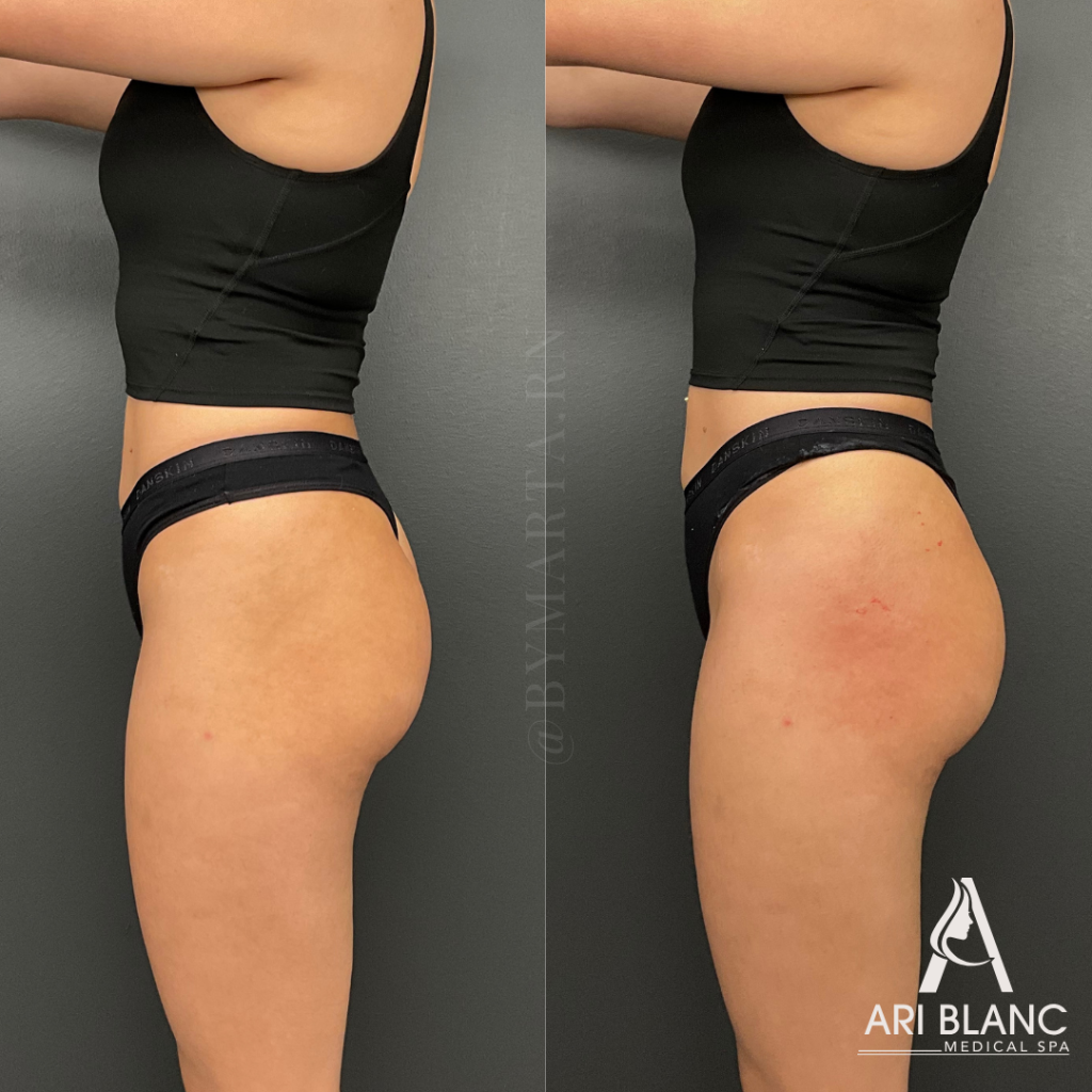 Sculptra Non-Surgical BBL Booty Lift Before and After Side Profile | Ari Blanc Before and after side-profile photos of Sculptra non-surgical BBL treatment showing fuller buttocks, smoother hips, and improved hip dip contour.