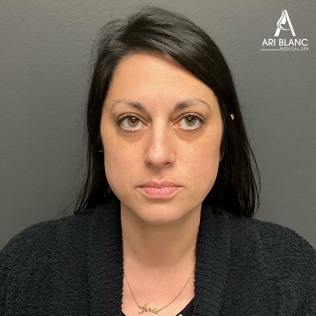 Restore Volume Sculptra Before and After at Ari Blanc Medical Spa Philadelphia
