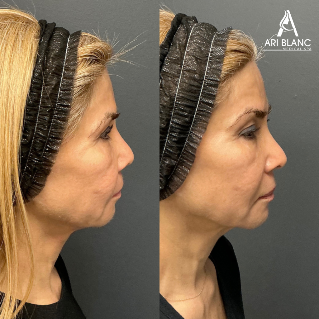 Side Profile Sculptra Before and After Philadelphia | Ari Blanc Side profile Sculptra before and after in Philadelphia showing restored facial volume, improved contour, and softer age-related hollowing.