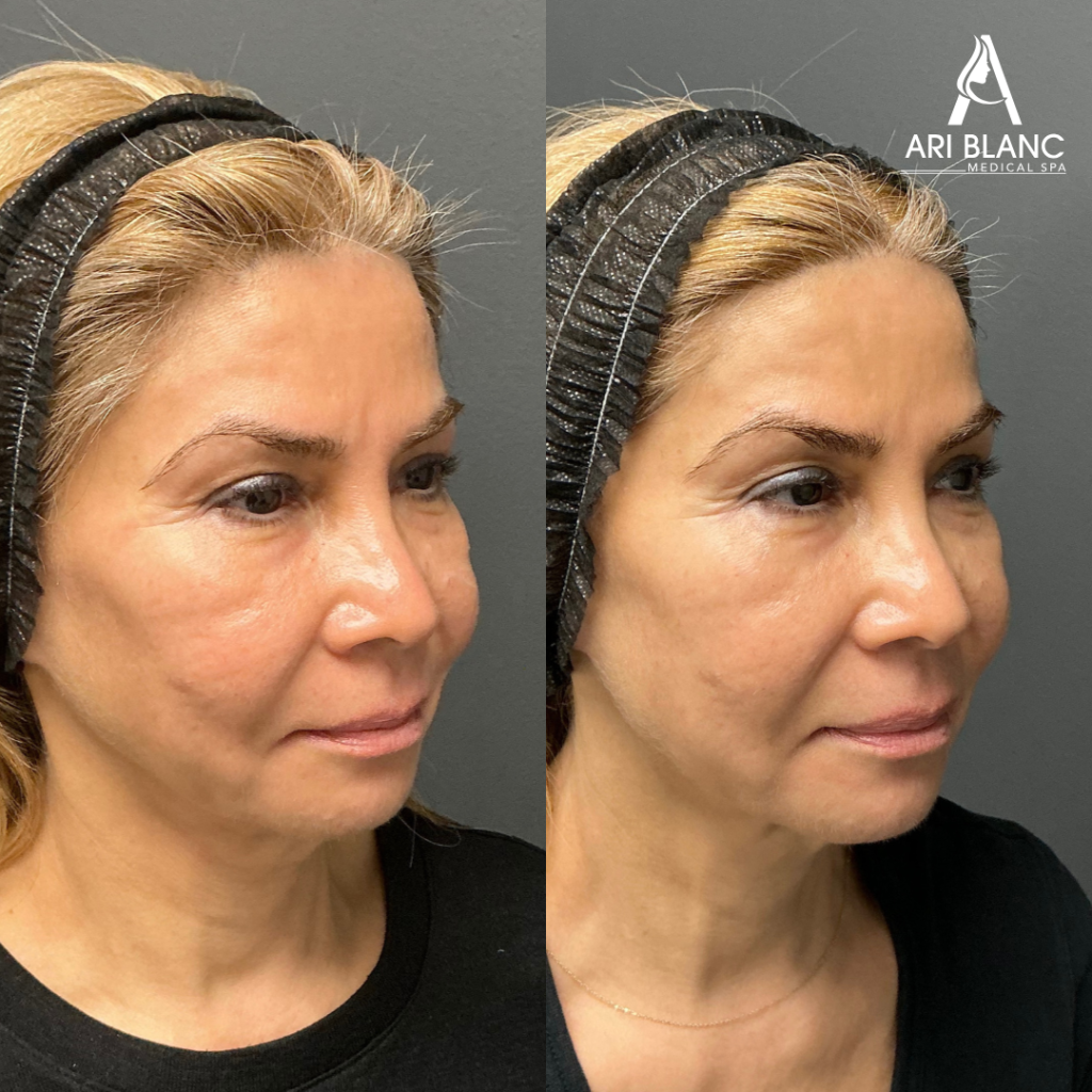 Sculptra Facial Volume Restoration Before and After | Philadelphia Sculptra before and after in Philadelphia showing improved cheek volume, smoother facial contours, and natural-looking fullness.