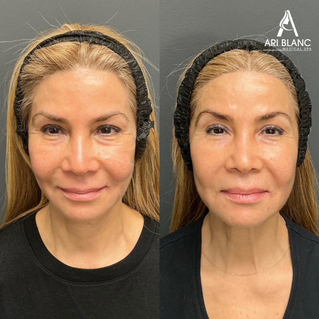 Sculptra Before and After Philly | Ari Blanc Medical Spa Sculptra before and after in Philadelphia showing restored facial volume, improved cheek fullness, and a more refreshed appearance.