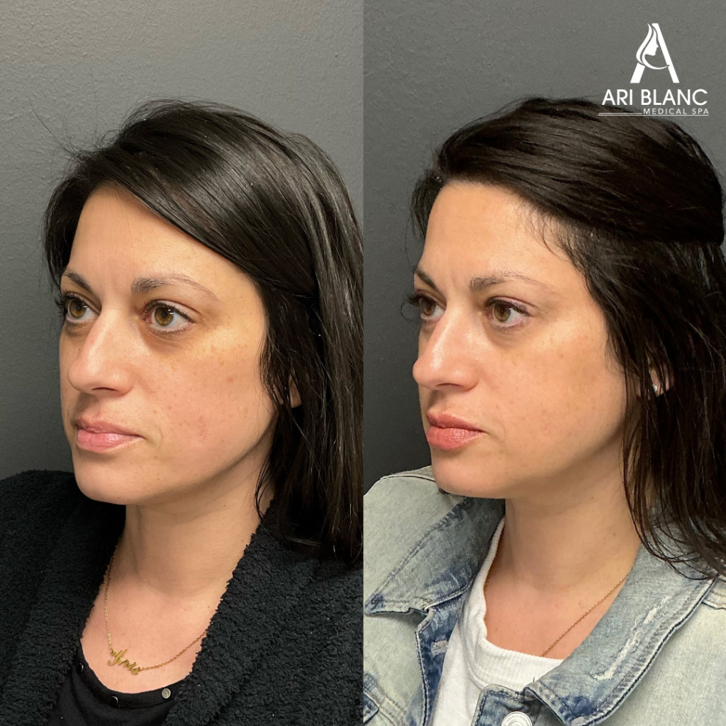 Sculptra Before and After for Natural-Looking Volume | Philadelphia Sculptra before and after in Philadelphia showing restored facial volume, improved cheek contour, and natural-looking collagen-supported rejuvenation.