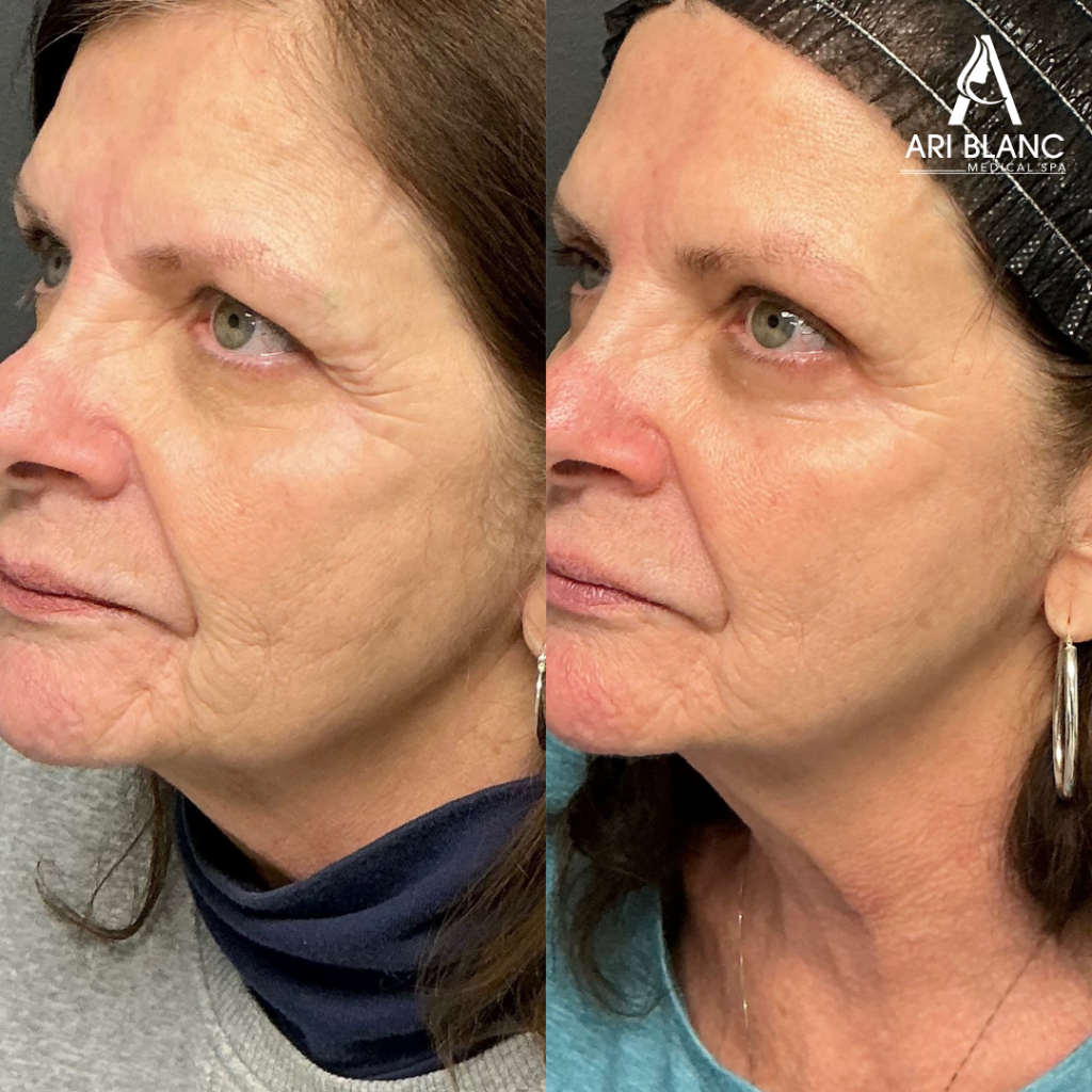 Sculptra Gradual, Natural looking Fullness Sculptra for Facial Volume Loss Before and After | Philadelphia Sculptra before and after in Philadelphia showing improved facial fullness, smoother contours, and natural-looking rejuvenation for age-related volume loss.