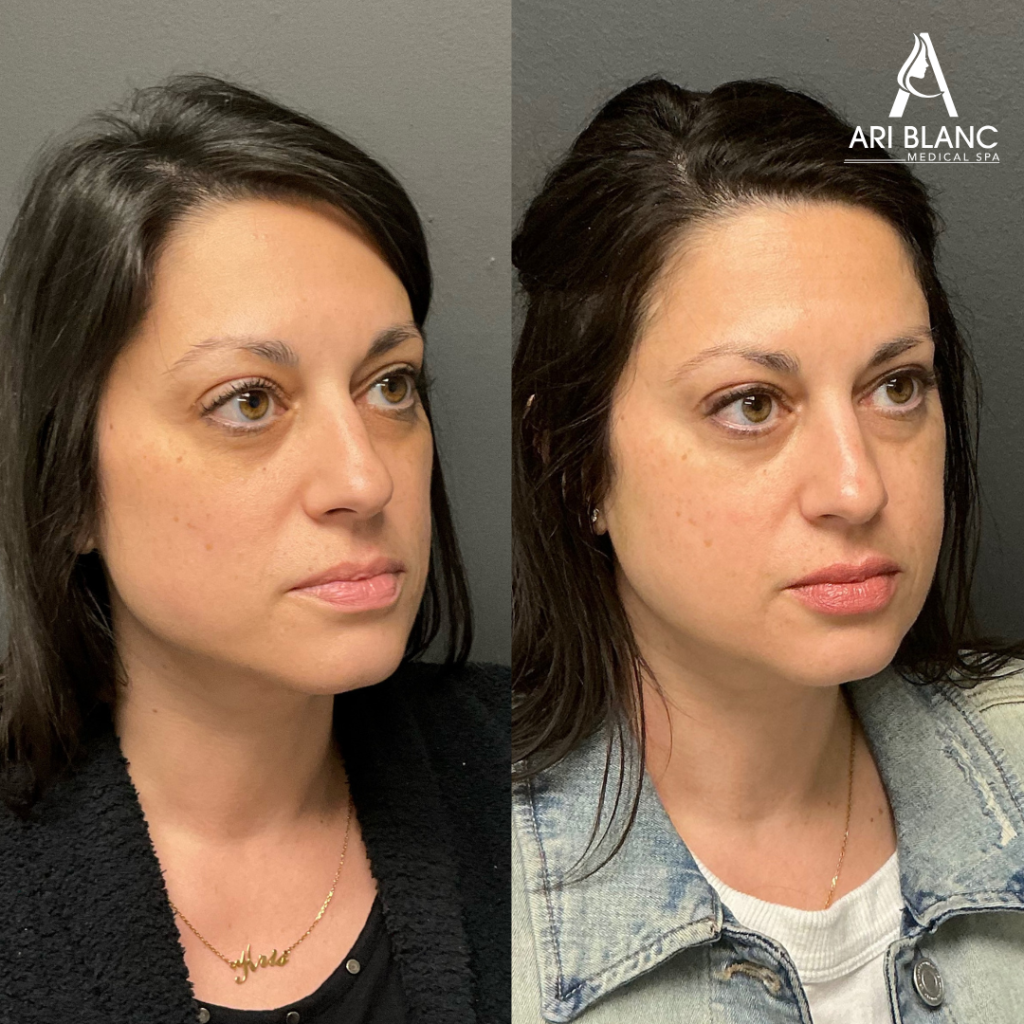 Sculptra Facial Balancing Before and After Philadelphia | Ari Blanc culptra before and after in Philadelphia showing subtle facial volume restoration, improved contour, and natural-looking facial balancing.